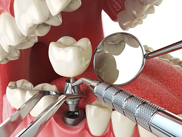 Best Emergency Dental Extractions in Mission, SD